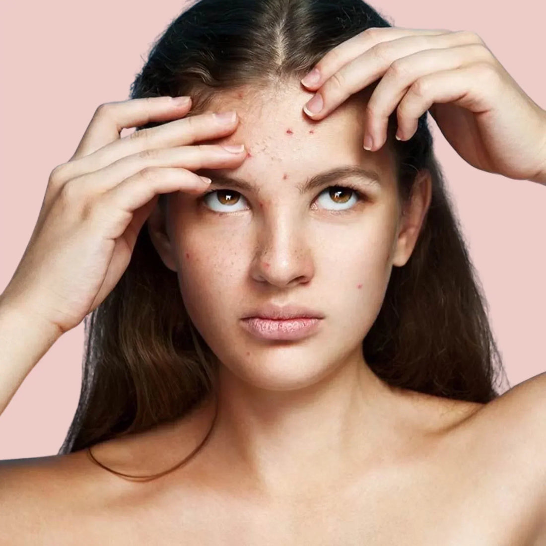 Acné et psychologie : Quand les boutons affectent l’estime de soi